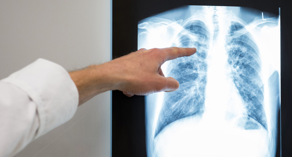 Ein Arzt zeigt auf das Röntgenbild einer Lunge.