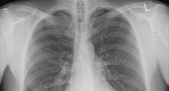 Röntgenbild einer Lunge