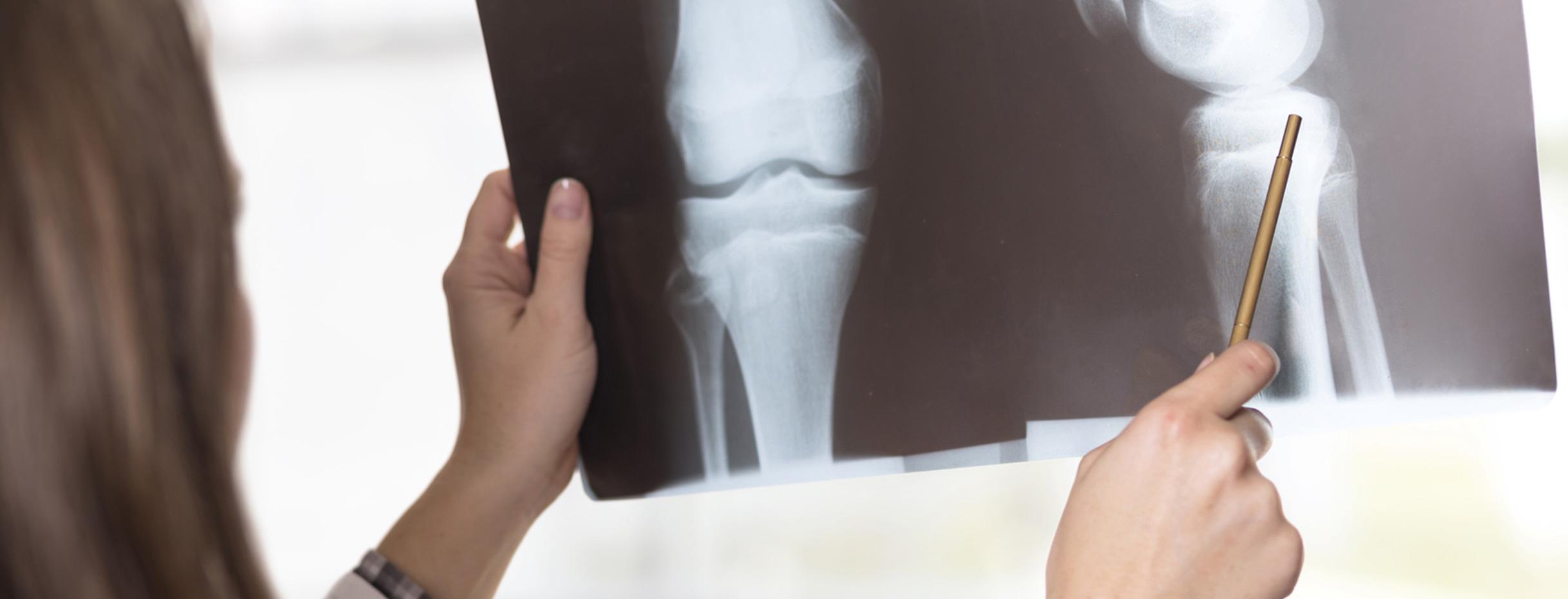 Ärztin schaut sich Röntgenbild eines Kniegelenks an